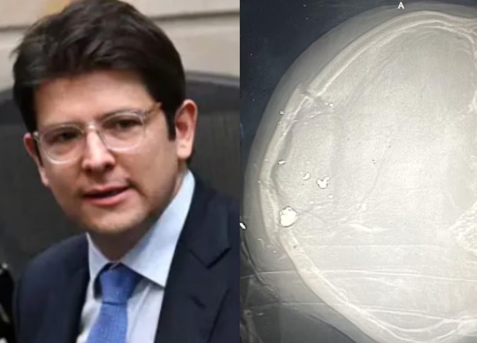 Filtraron radiografía de Miguel Uribe: así quedó su cráneo tras el atentado